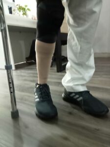 prosthetic leg cost