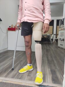 prosthetic leg near me